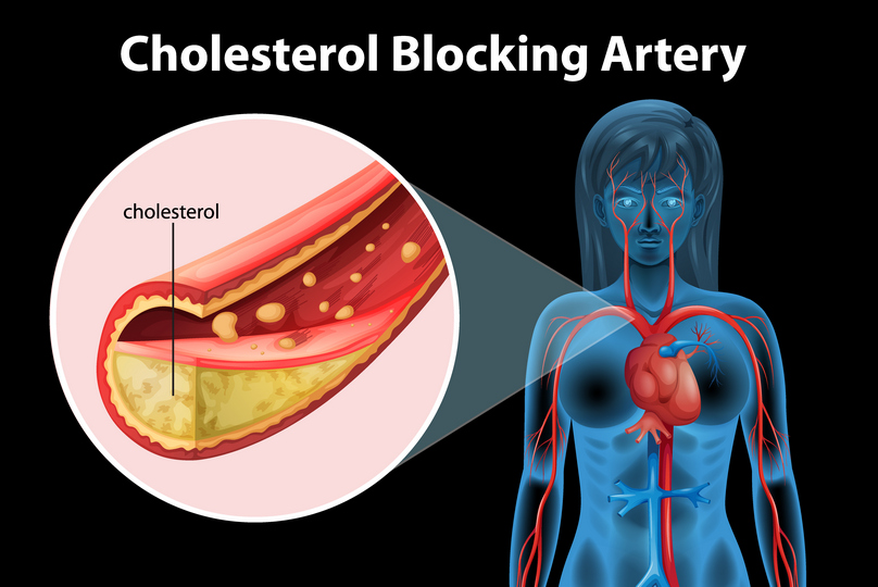 Holesterol blokira arteriju, ilustracija