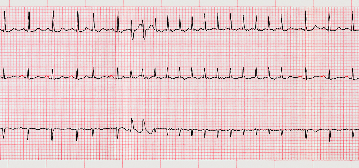 EKG sa nepravilnim radom srca