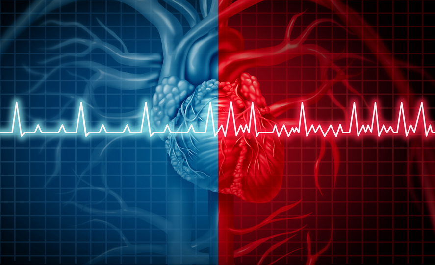 EKG ilustracija pravilnog i nepravilnog srčanog ritma